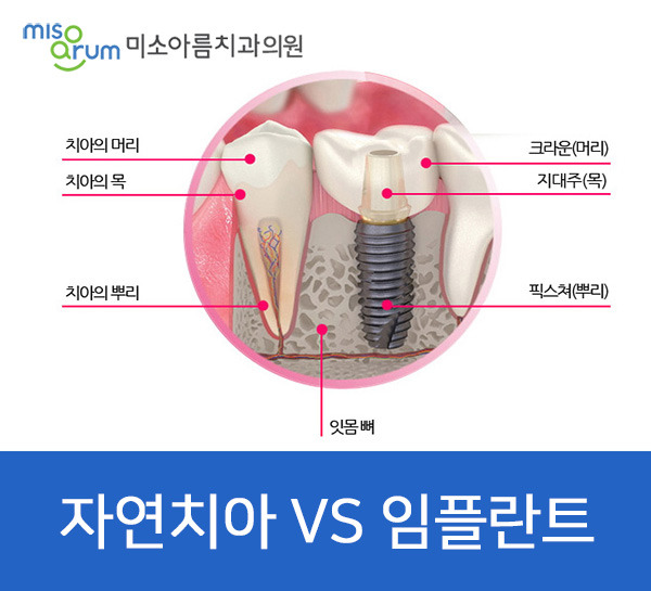 전주임플란트치과 빠진 치아를 방치할 경우 나타나는 문제점